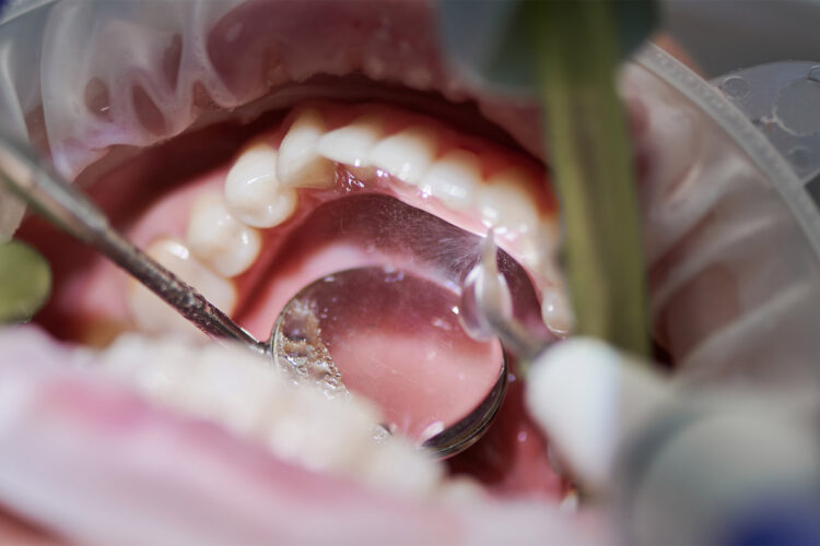 Dental Tartar